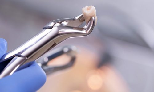 cirurgia-dentaria-figueiredo-filho