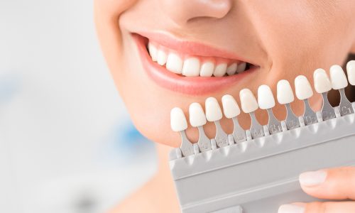 Beautiful,Smile,And,White,Teeth,Of,A,Young,Woman.,Matching
